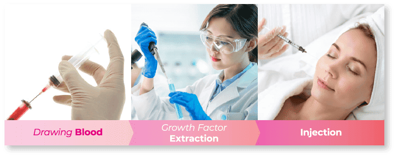 Drawing Blood > Growth Factor Extraction > Injections Into the Skin