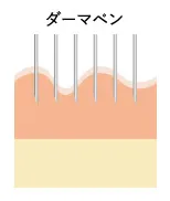 超極細針で微細な穴を開けて、成長因子やヒアルロン酸を浸透させます。