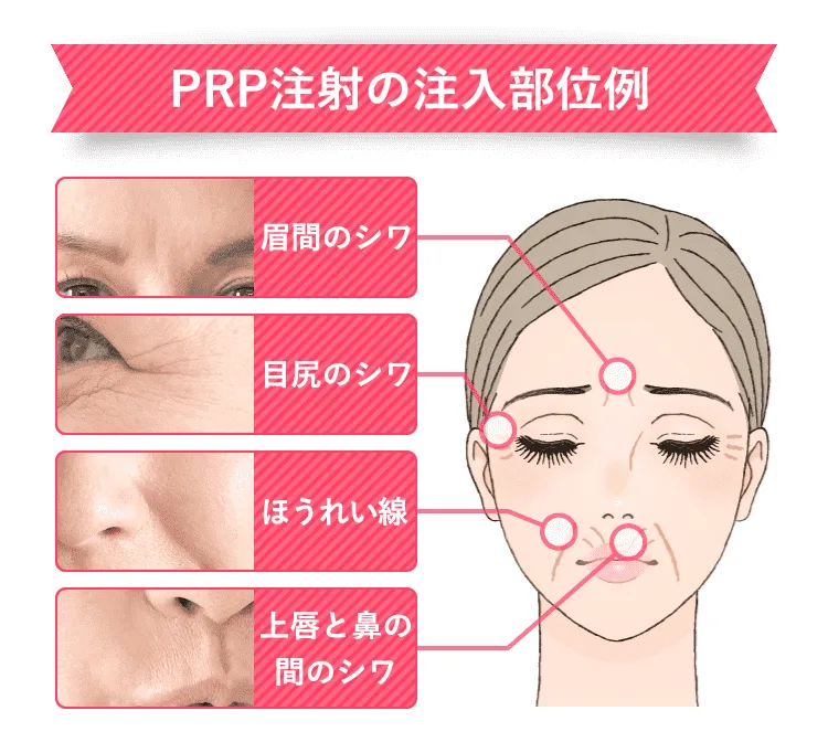 PRP注射の注入部位例