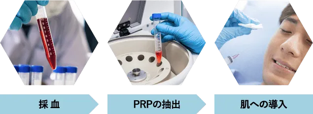 PRP注射 for MENで使用する成長因子は