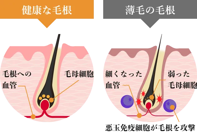 薄毛の毛根の特徴