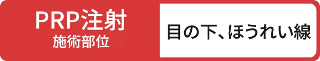 PRP注射施術部位：目の下、ほうれい線