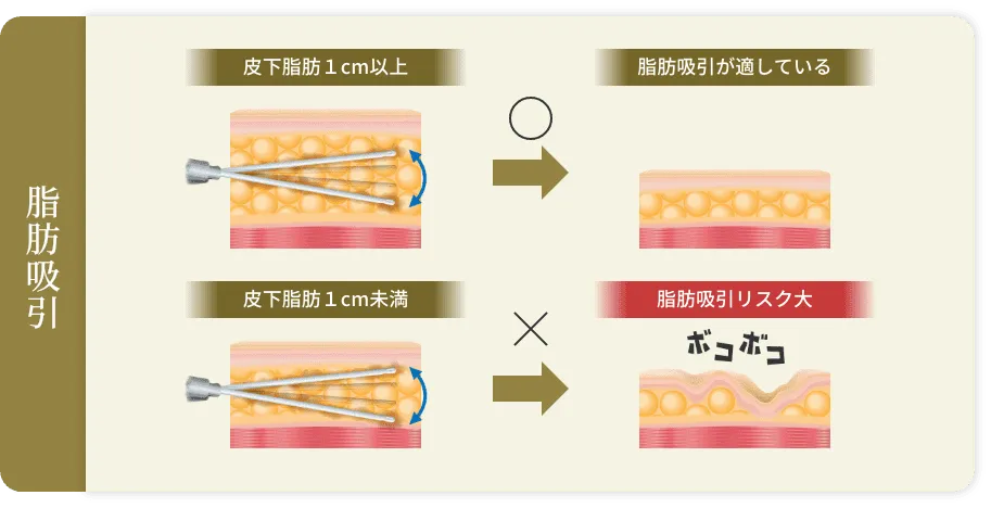 脂肪吸引